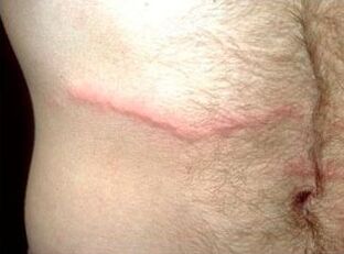 Como desfacerse dos parasitos subcutáneos en humanos